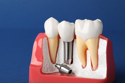sección transversal del implante dental