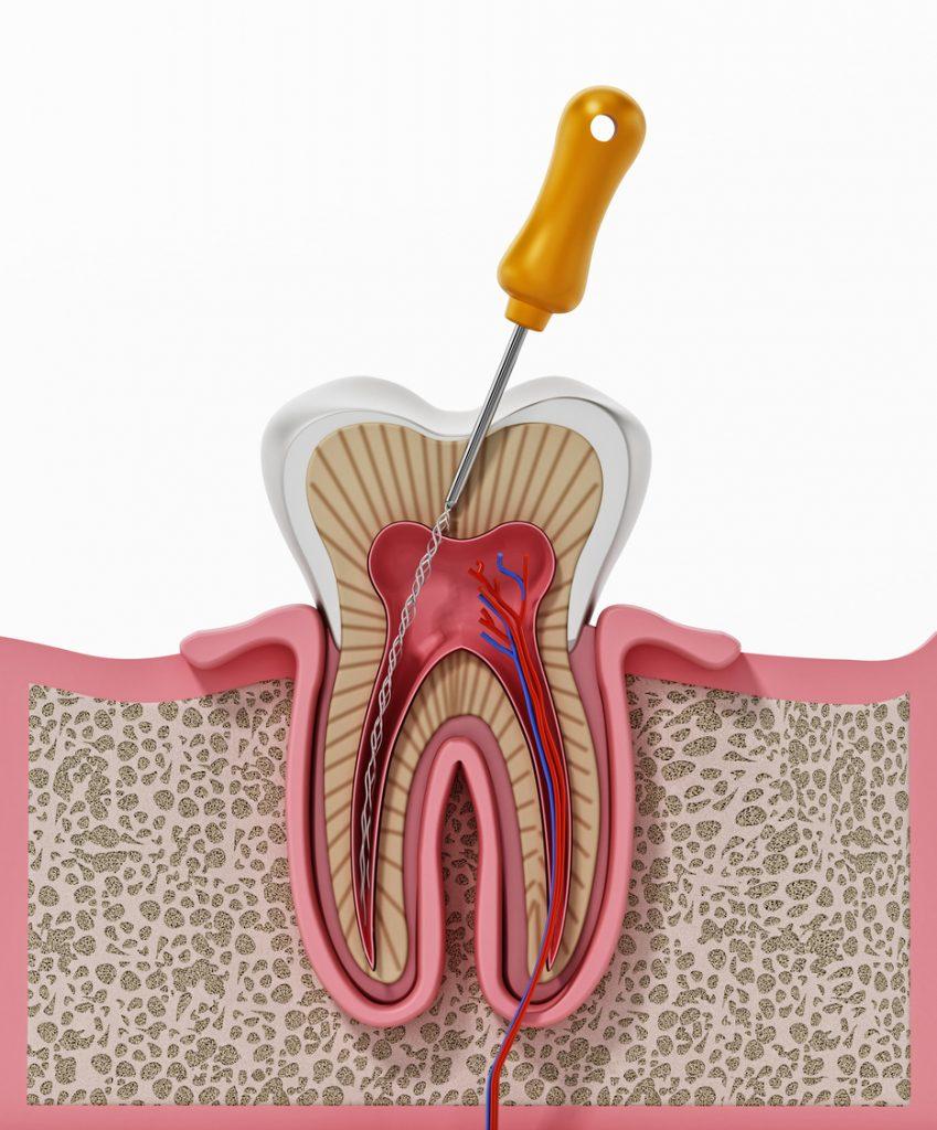 Endodoncia en servicios odontologos