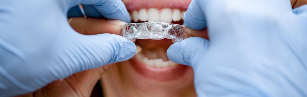 ORTODONCIA INVISIBLE Ortodoncia en Clinica Denticor