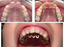 ORTODONCIA PEDIÁTRICA Ortodoncia en Clinica Denticor