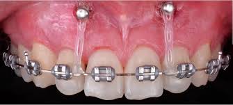 TÉCNICA HÍBRIDA Ortodoncia en Clinica Denticor